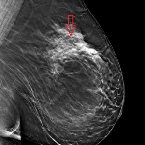 Architectural Distortion L MLO Breast Tomosynthesis