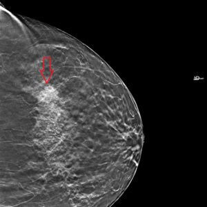Architectural Distortion L CC Breast Tomosynthesis