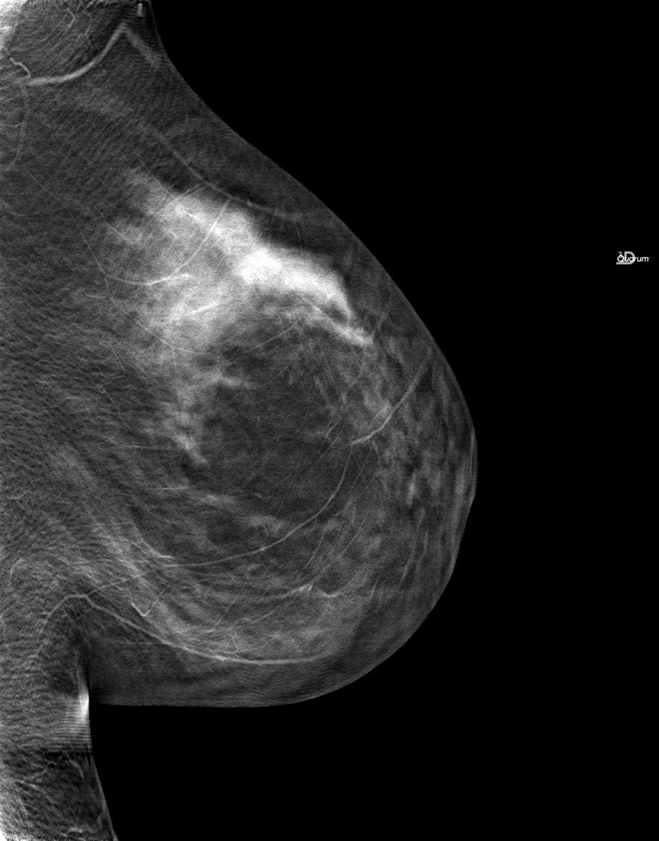 Is my ‘questionable distortion’ breast cancer? We wait.